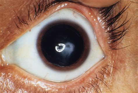 Keratoconus 1 | Hereditary Ocular Diseases