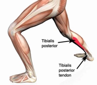 Posterior Tibialis Tendon Dysfunction: Signs, Symptoms, & Treatment – NutraBio Brands