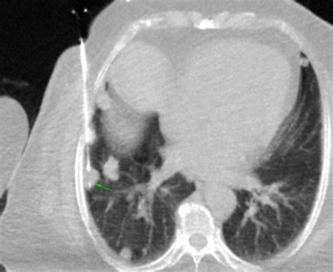 Chest - CT Guided Biopsy