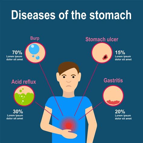 Stomach Ulcers | Stomach ulcers, Ulcers, Stomach