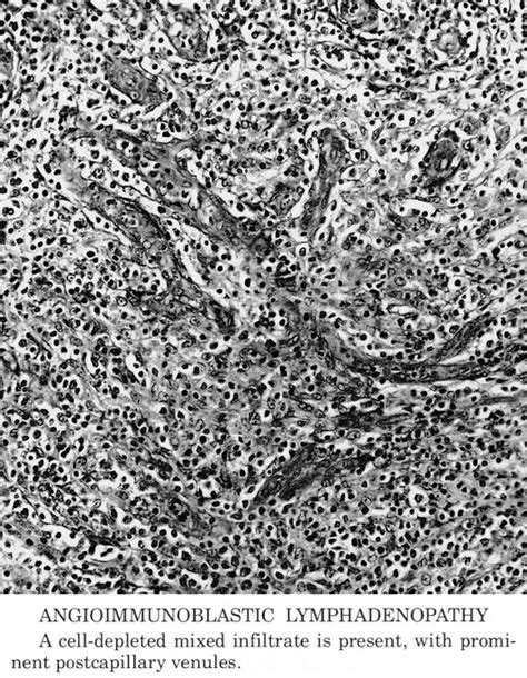 Pathology Outlines - Angioimmunoblastic T cell lymphoma