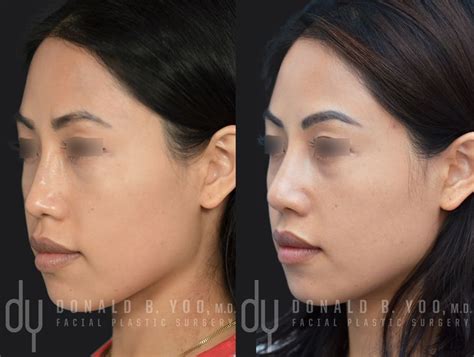 Before and After Primary Asian Rhinoplasty with Rib Cartilage and DCF # ...