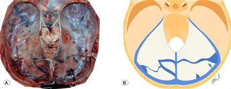 Dissection photo of cadaver 14 (A) and its illustration (B) showing a... | Download Scientific ...