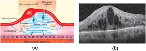 a Conceptual DME illustration, b DME image from OCT | Download Scientific Diagram