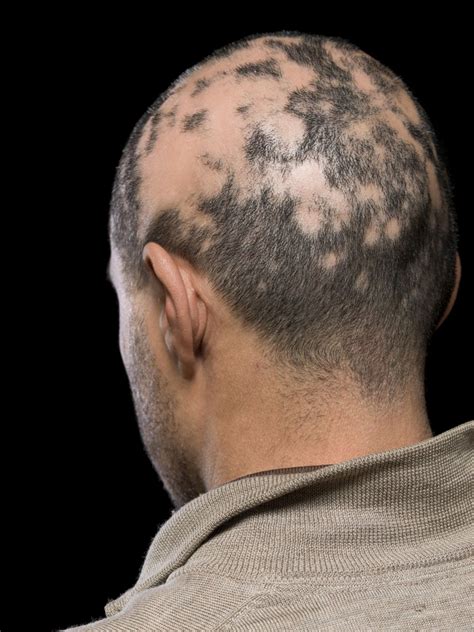 Current alopecia areata options include old and new therapies | MDedge ...