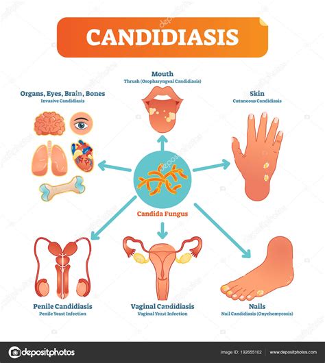 Pin by Delia Carcamo on Candida diet | Candidiasis, Yeast infection, Candida fungus