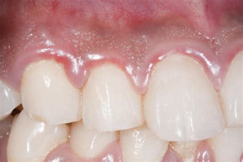 Swollen gums: Causes, treatments, and home remedies