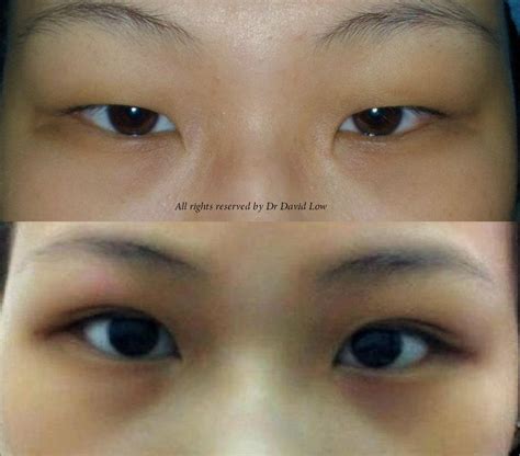 The Art & Science of Beauty : Double Eyelid Surgery