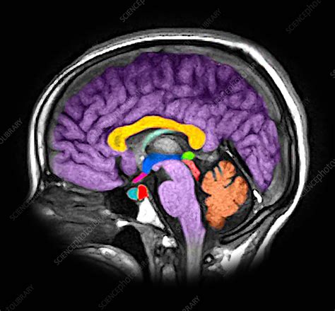 Enhanced Normal Sagittal MRI Brain - Stock Image - C043/5536 - Science Photo Library