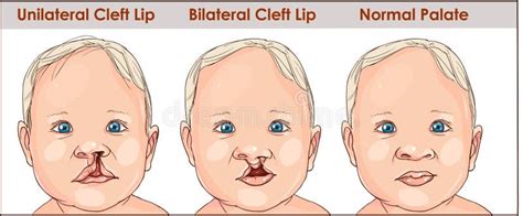 Illustration of a Cleft Palate in a Child. Plastic Surgery Stock Vector ...