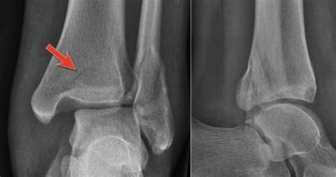 발목 골절(Fracture of ankle) : 발목이 비틀리면서 발목 뼈가 부러졌어요 : 네이버 블로그