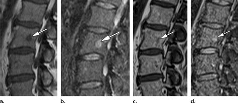 Atypical Hemangioma Spine Mri