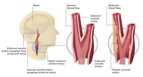 Carotid Artery Test With Dye - mapasebab