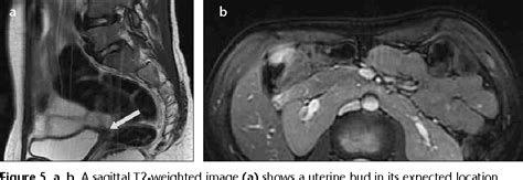 [PDF] MRI in the diagnosis of Mayer-Rokitansky-Kuster-Hauser syndrome ...