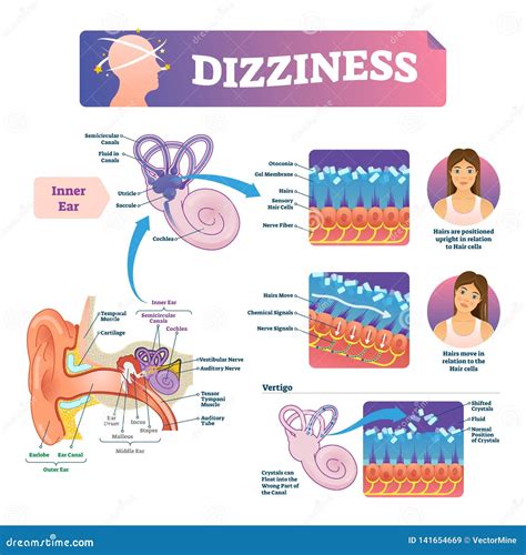 Dizziness Vector Illustration. Labeled Scheme With Inner Ear And ...