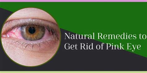 Natural Remedies to Get Rid of Pink Eye-conjunctivitis - Sanjivani ...