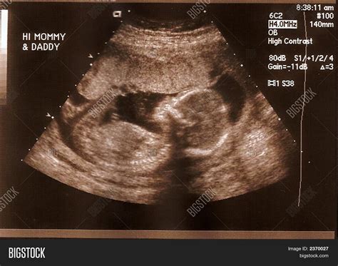 Ultrasound 18 Weeks Image & Photo | Bigstock