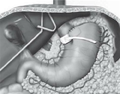 Vertical-banded gastroplasty | Download Scientific Diagram