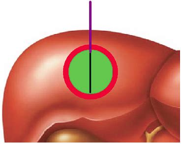 Liver Ablation | Oncohema Key