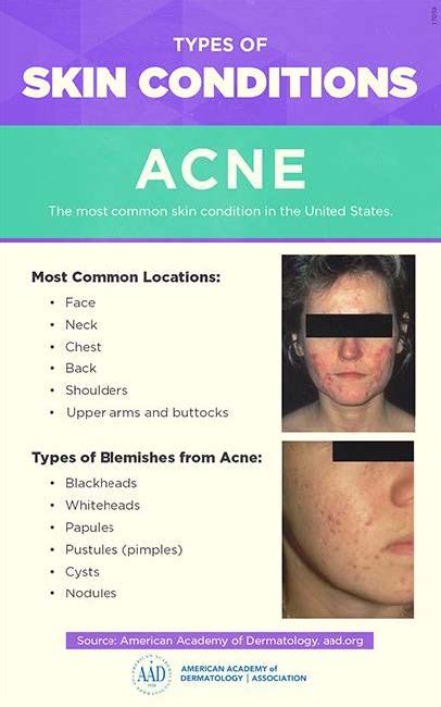 Acne Treatment Dermatologist