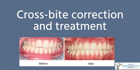 What Is A Crossbite? Signs, Effects, and Treatment - Miami Orthodontist Group