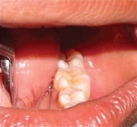 Left mandibular first molar with 6 cusps and second molar with 5 cusps ...