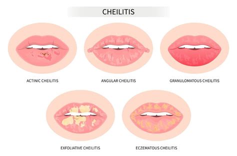 Cheilitis