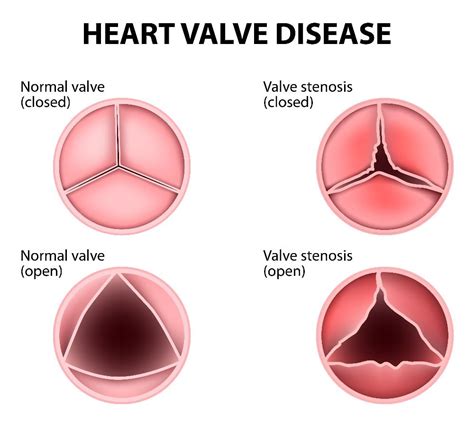 Frequently Asked Questions About Heart Valve Disease - Facty Health