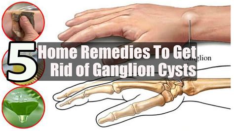 Ganglion Cyst Ankle Home Treatment : How to get rid of ganglion cysts with this home remedies ...