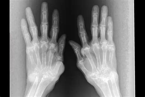 Rheumatoid Arthritis in the Wrist: Symptoms, Treatments and More