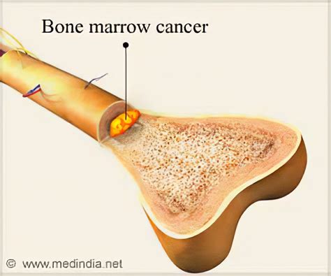 Cancer Of Bone Marrow - CancerWalls