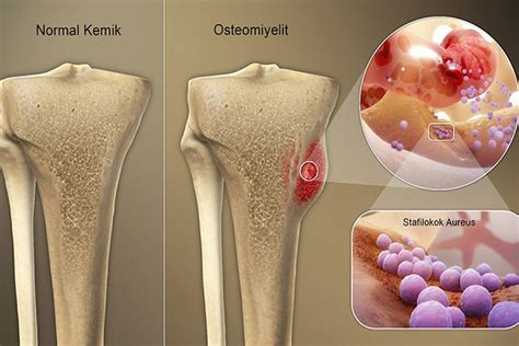 WHAT IS BONE INFLAMMATION?