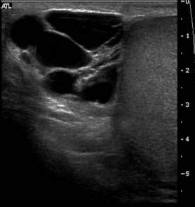 US Epididymis - Multilocular epididymial cystic lesion syggestive of Spermatocele. | Ultrasound ...