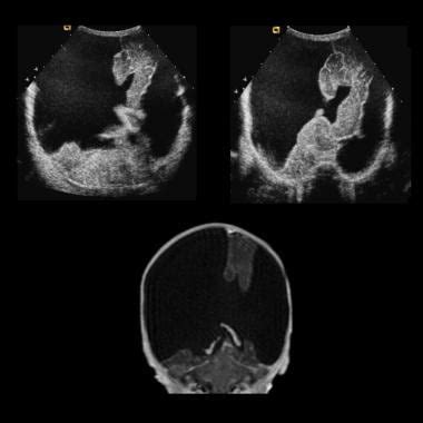 Schizencephaly Imaging: Practice Essentials, Computed Tomography, Magnetic Resonance Imaging