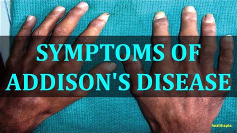 SYMPTOMS OF ADDISON'S DISEASE | Addisons disease, Addison’s disease ...