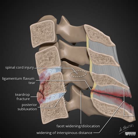 Flexion teardrop fracture illustrations | Radiology Case | Radiopaedia.org | Radiology, Medical ...