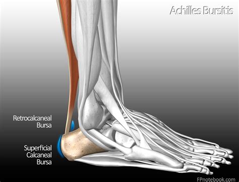 Achilles Tendon Bursitis