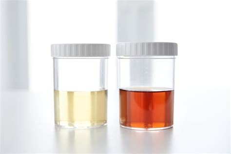 Foamy Urine: Is it a Symptom of a Kidney Disease? | BlackDoctor.org