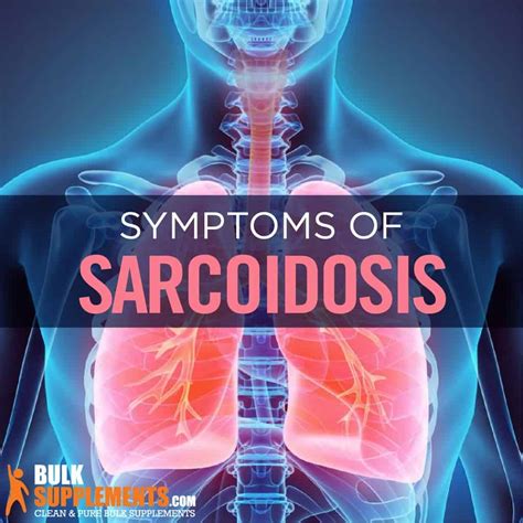 Sarcoidosis: Symptoms, Causes & Treatments