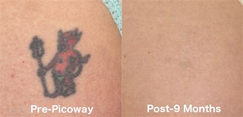 Picoway Tattoo Removal San Diego, CA | Cosmetic Laser Dermatology