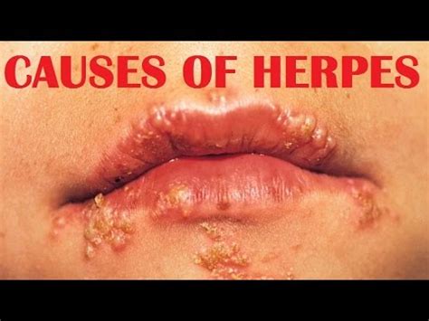 Herpes Simplex Virus : causes, symptoms and treatment - YouTube