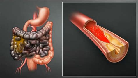 Intestinal Ischemia Treatment and Cure in Chennai | CLASS