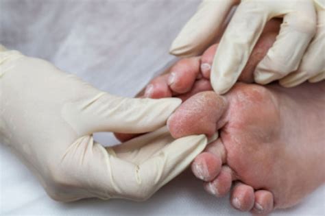 Managing Diabetic Foot Infections