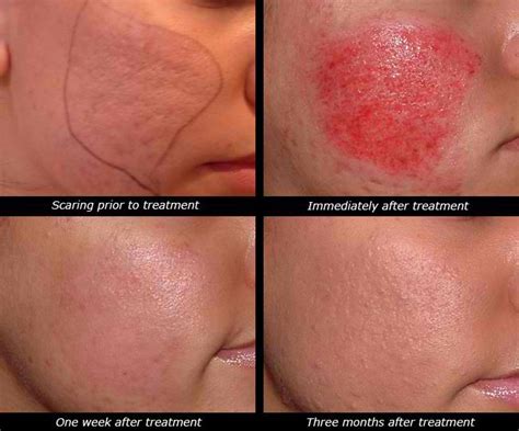 Dermapen for Acne Scar Removal