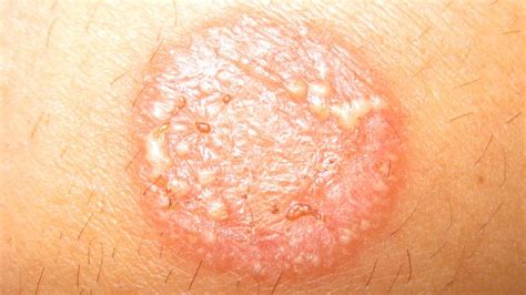 Ringworm In Humans Treatment