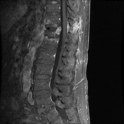 Radiology Cases: Chance Fracture I -- Initial MRI