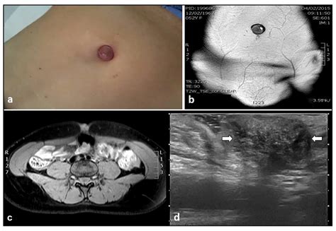 Abdominal Mass Ultrasound