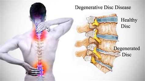 Degenerative Disc Disease Surgery : Causes, Symptoms, in India