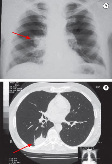 Histoplasmosis - Causes, Symptoms, Diagnosis, Prognosis, Treatment