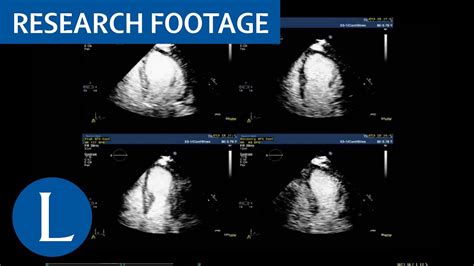 Dobutamine stress echocardiography to diagnose coronary artery disease ...